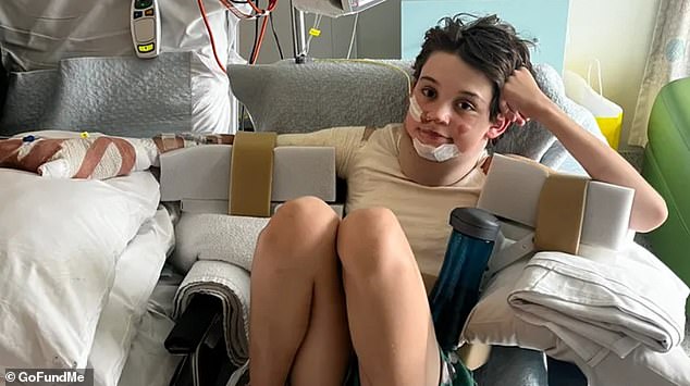 Levi has undergone eight operations to treat his burns, with his parents hoping their son's story will help parents recognize the dangers of synthetic clothing