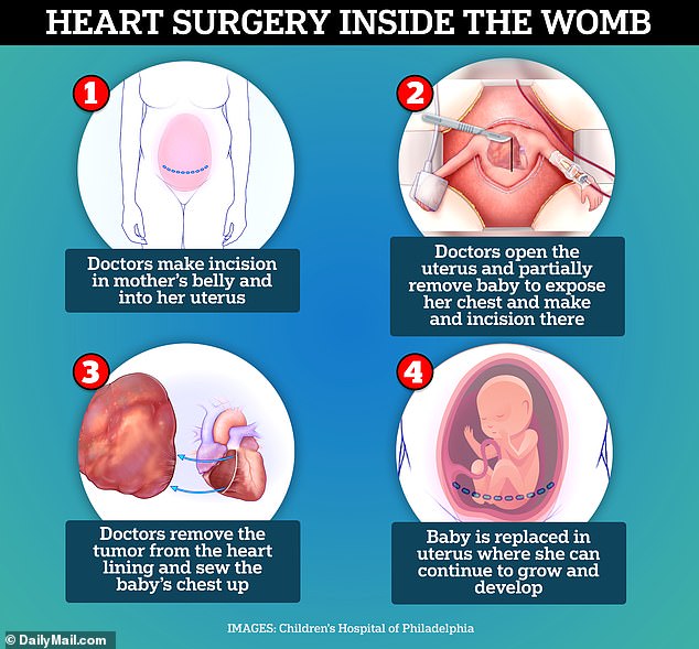 The doctors partially removed Arley from her mother's uterus by puncturing the amniotic sac, but did not deliver her completely, leaving her protected in the fluid. Specialized devices maintained amniotic fluid levels to minimize risks and prevent the uterus or placenta from reacting to the surgery