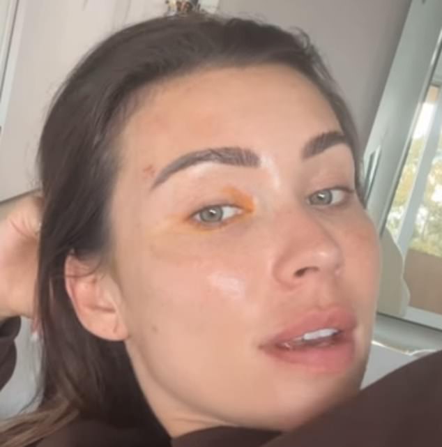 The influencer, 36, married to businessman Nick Russian, 45, shared a lengthy Instagram post detailing her health issues and showing off her nasty eye rash (pictured)