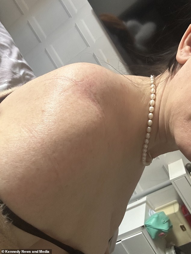 Doctors initially said it was a torn ligament, but Mrs Turner became concerned weeks later when she noticed a slight swelling on the top of her shoulder, the size of a £2 coin.