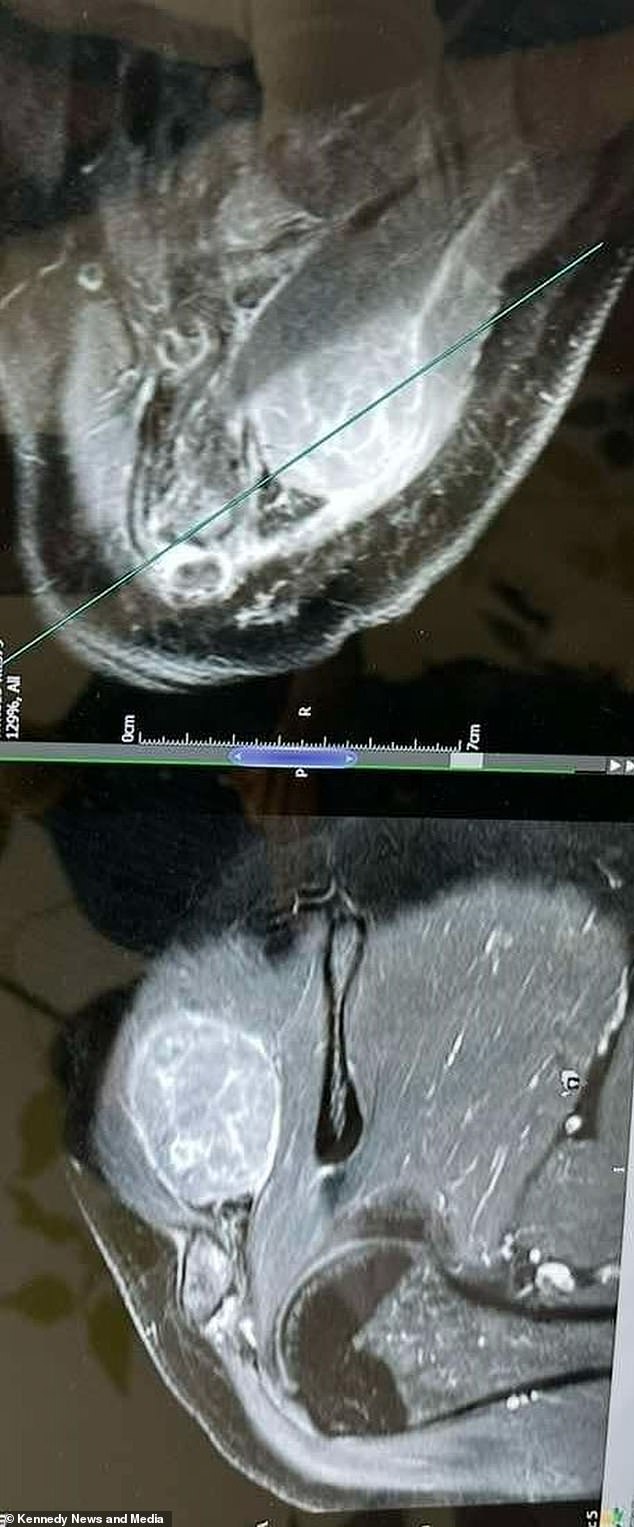 In January, Ms Turner underwent a biopsy and scans which revealed stage four melanoma. The image above shows the scan of Mrs Turner's shoulder, with the tumor in white