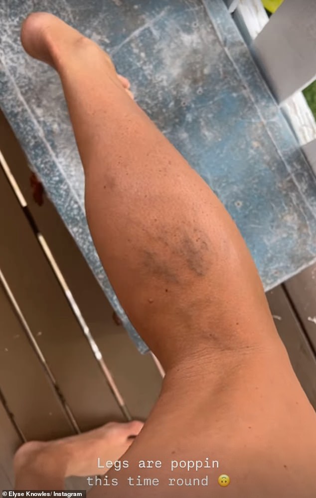 The model, 32, who is expecting her third child with fiancé Josh Barker, 35, took to her Instagram Stories on Friday to share a video of her bruised legs