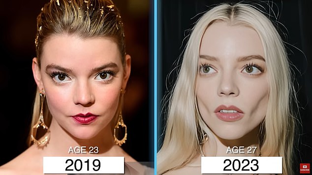 Plastic surgeons also suggested that Anya Taylor-Joy had buccal fat removal. Dr. Linkov suggested she had undergone the procedure in one of his videos, after comparing photos of her from 2019 to 2023