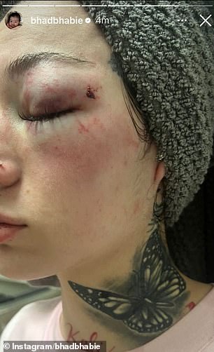 She followed the video with photos of herself with a nasty black eye and bruises all over her face