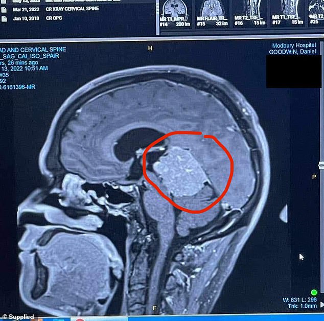 Mr Goodwin's MRI revealed a 5.2cm tumor in his brain, pressed against a main artery