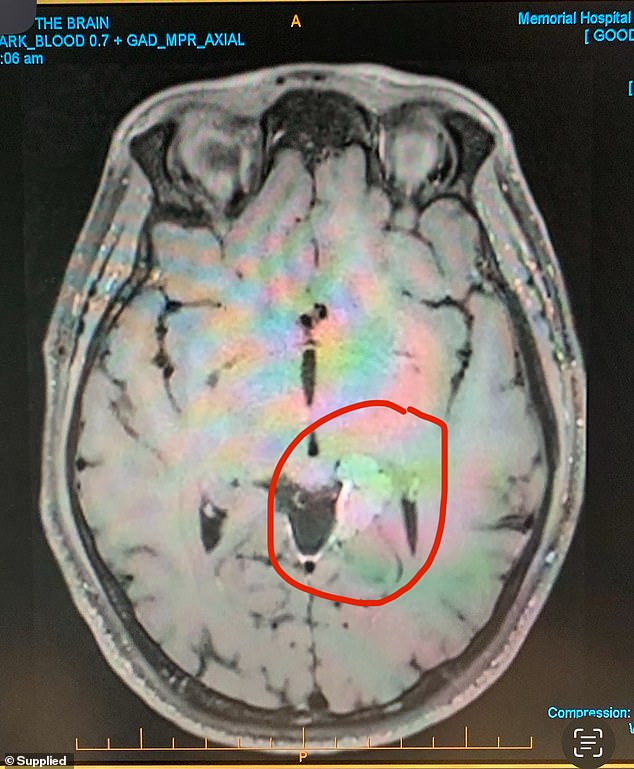 The tumor (pictured) has since grown back to about half its original size, about 2.9mm