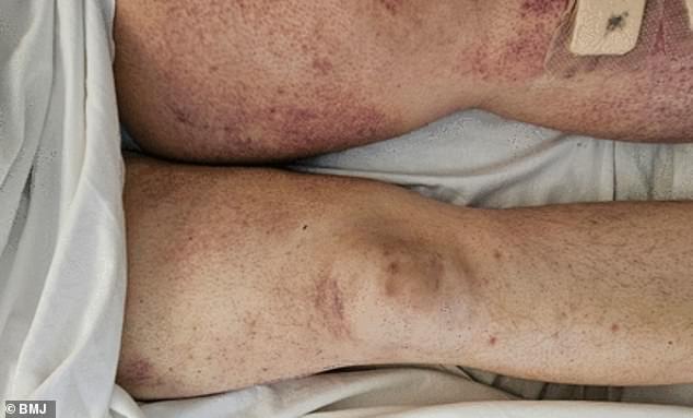 The man, who recently underwent bariatric weight loss surgery, had a reddish-brown rash that covered his legs (pictured) and spread to his hands and arms