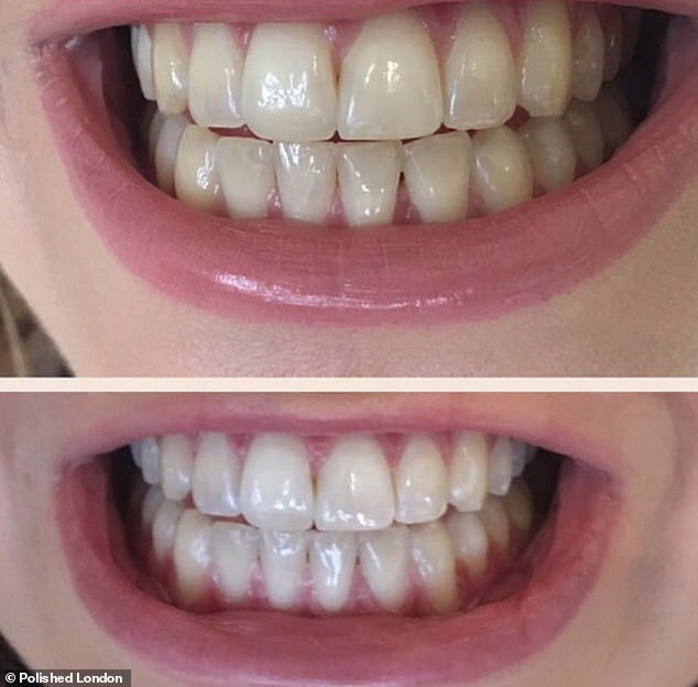 Many shoppers have shared incredible 'before' and 'after' results, with many claiming their teeth were 'visibly brighter and whiter' within two weeks of regular use