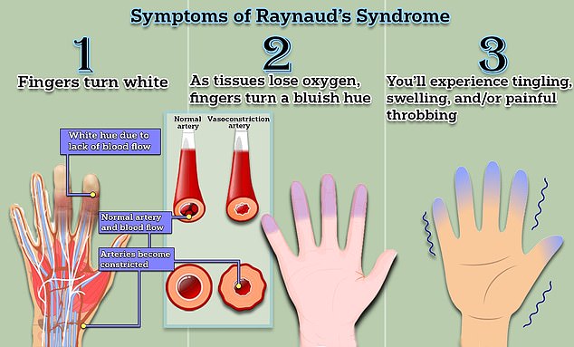 Raynaud's disease causes miniature spasms in the blood vessels, cutting off blood flow to the fingers and toes