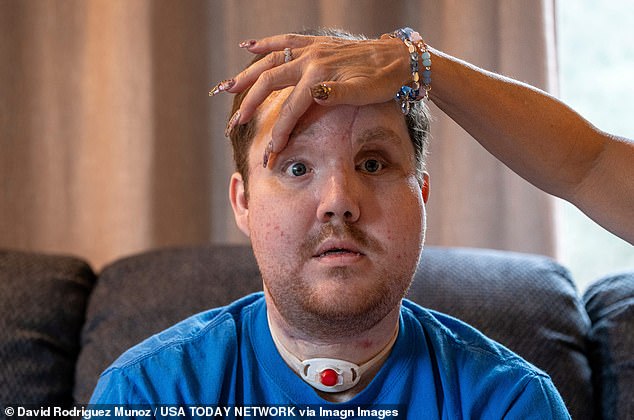 The facial reconstruction surgery involved more than 80 medical professionals over a 60-hour period, reconstructing approximately 85 percent of Derek's face