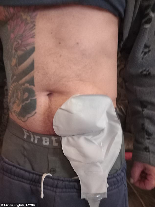 Mr English was fitted with a colostomy bag, in which one end of the colon is diverted through an opening in the abdomen. The waste products then collect in a bag attached to the opening.