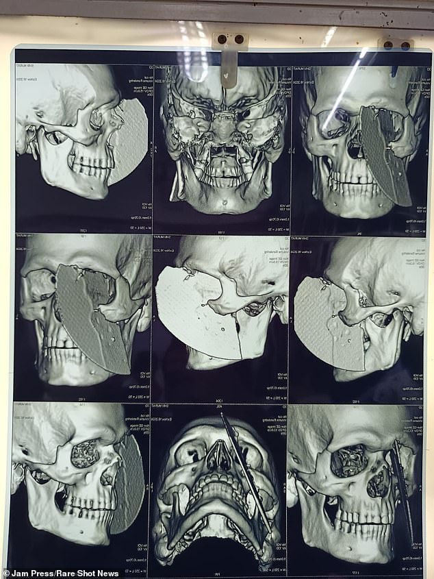 X-rays taken before the worker's surgery show the metal blade embedded in half of his face