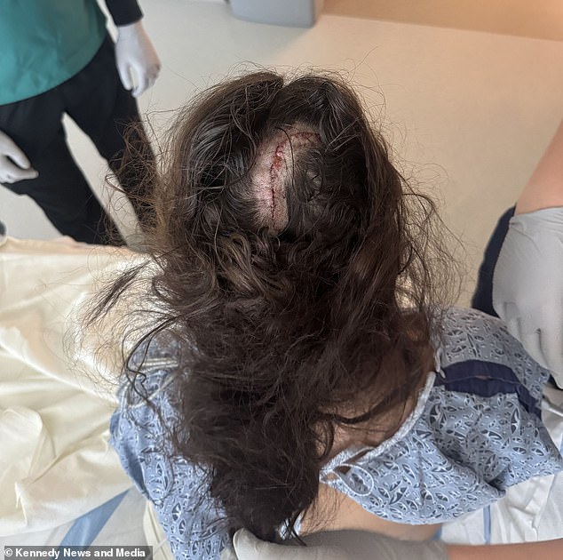 Doctors made an incision in her scalp and removed part of her skull. They then extracted the tumor, taking care not to damage the healthy tissue around it