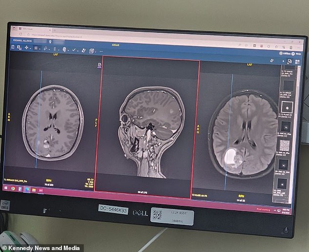 Allison's tumor was located in her occipital lobe, the visual processing center of the brain.