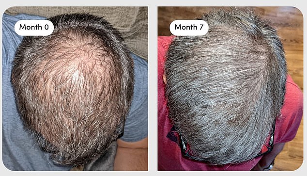 The above images, from him, show a man before taking finasteride and seven months after starting the drug