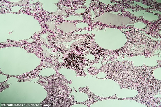 Silicosis causes internal scarring and inflammation of the lungs through the fine particles that workers inhale. Depicted silicosis of the lung tissue under magnification