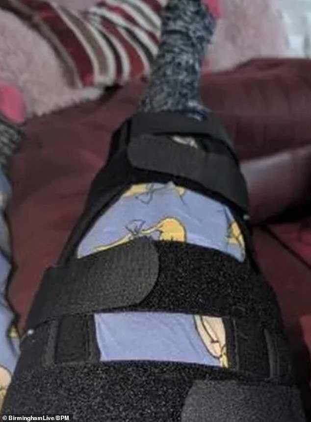 An Aston Villa supporter, 33, suffered serious leg injuries and said it was fortunate no one was killed after a large car drove towards her and other supporters. In the photo: the injured leg of the victim in a brace