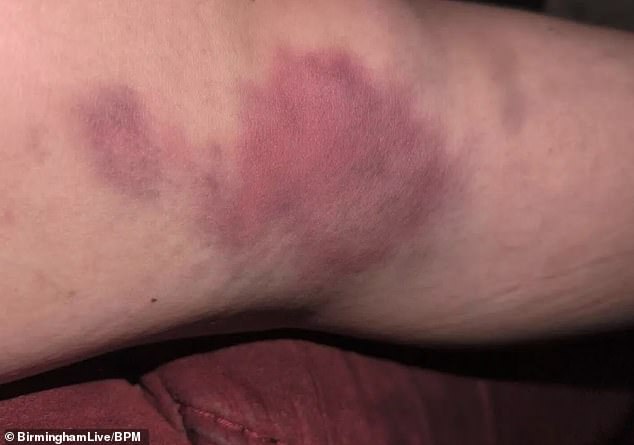 The fan had been to the game with her grandmother and niece before tragedy struck, saying the car hit her on the side of her knee. In the photo: extensive bruising suffered by the victim