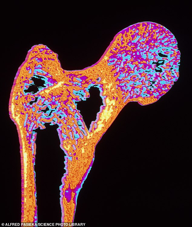 Research has long suggested that too much thyroid hormone accelerates bone loss, increasing the risk of the bone-thinning disease osteoporosis. Pictured: An X-ray of the head of a femur of the femur affected by osteoporosis