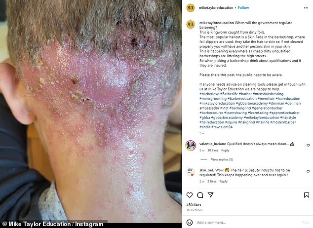 Hairdresser Mike Taylor, who raised the alarm last week about the worrying rise in ringworm cases, has also shared images of clients affected by the condition.