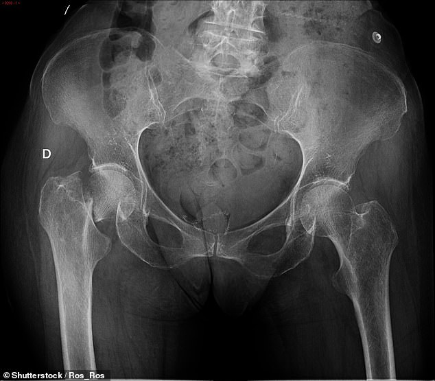 This X-ray shows a woman with a broken hip, which Yale says is one of the most debilitating fractures associated with osteoporosis. Thyroid problems are much more common in women than in men.