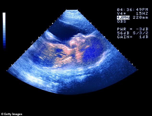 Between 2012 and 2022, the number of single women using IVF or donor insemination increased from 1,400 to 4,800 (stock image)