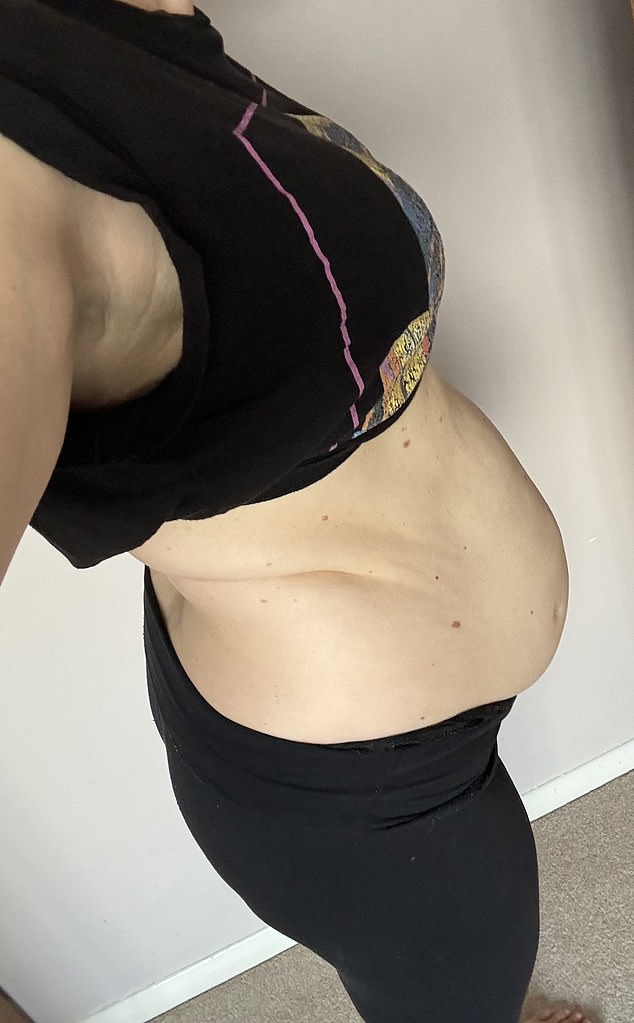 In most moderate cases, when the muscles do not come back together naturally, physical therapy exercises in the first year after birth usually help. In the photo: a woman with diastasis recti