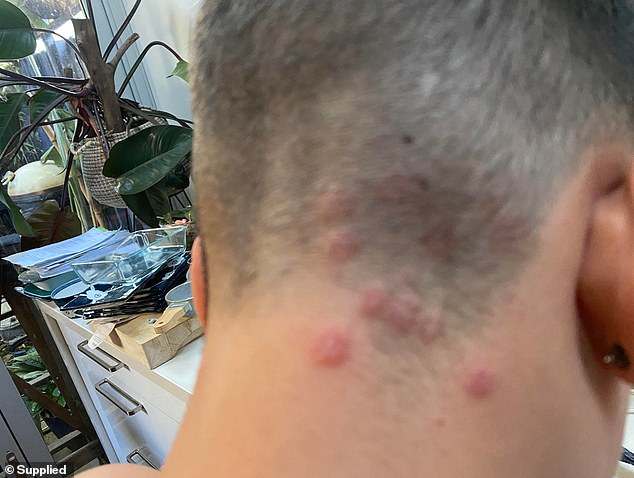 Hairdressers think this is because more and more men are opting for skin-fading haircuts. Pictured: A 2022 case in Australia of a boy who contracted ringworm after a visit to the hairdresser