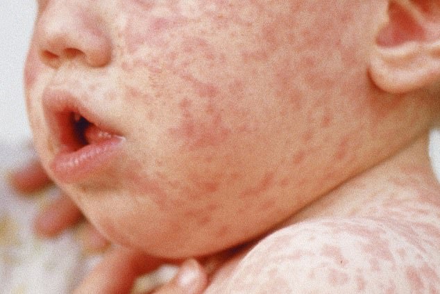 Measles in children can look like other skin rashes. The majority of people who died from measles in 2023 were under the age of five