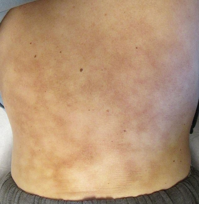 An article in the Cleveland Clinic Journal of Medicine looks at a severe case of erythema ab igne in a 42-year-old man