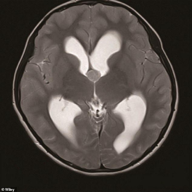 Colloid cysts, which are filled with a thick, gel-like substance called colloid, are often asymptomatic. Pictured is a case report published in the journal Wiley, showing the cyst in the center of the brain scan (gray circle)