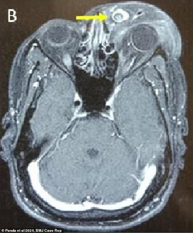 A brain scan before the surgery showed the mass, made of skin and blood tissue, sticking to the man's left eyelid