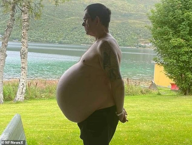 Thomas Kraut (pictured here), 59, noticed his stomach swelled for 12 years before doctors realized he had a huge tumor