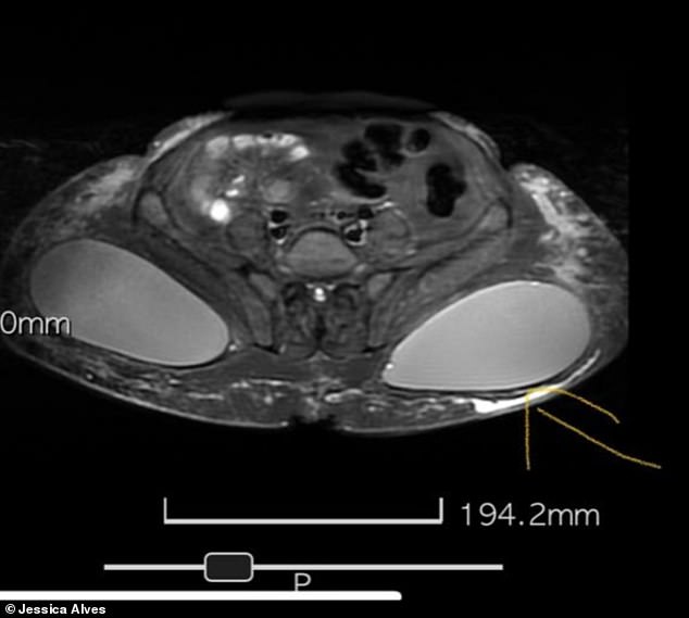 Shocking: Jessica's bottom X-ray shows the implants starting to emerge from the giant hole in her lower cheek