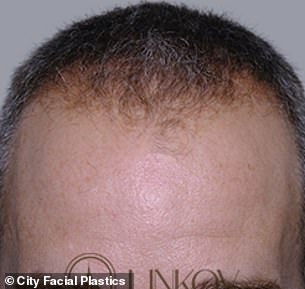 Above is a man's scalp before he took finasteride and minoxidil