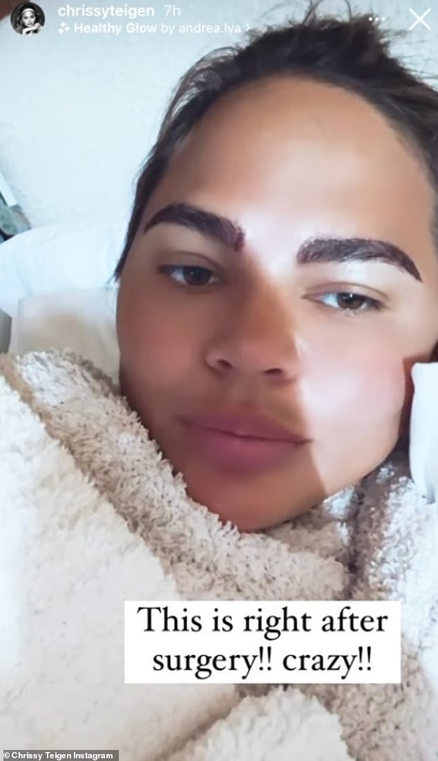 In 2021, model Chrissy Teigen revealed on social media that she had undergone an eyebrow transplant, which uses hair from the back of the scalp to fill in sparse eyebrows.