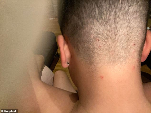 Cases of the contagious, disfiguring skin fungus have increased significantly in just a handful of months, they claim. Pictured: A 2022 case in Australia of a boy who contracted ringworm after a visit to the hairdresser