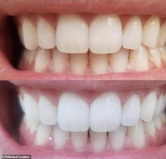 A dentist-approved 'ingenious' teeth whitening product is flying off the shelves after wowing hundreds of Australian customers with sparkling results