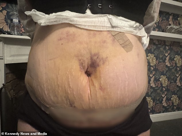 Ms Guest now faces further operations to remove the three hematomas in her stomach that doctors in Britain discovered