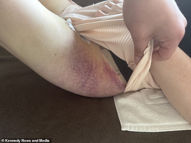 She was left covered in bruises after the 'mummy makeover' procedure