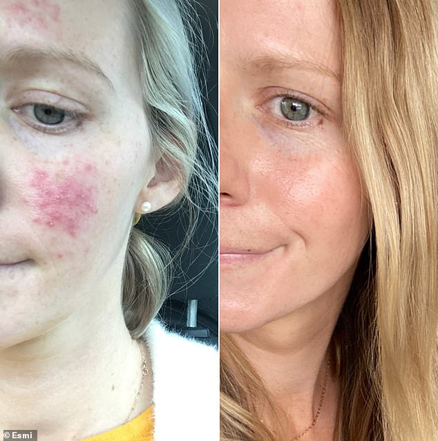 Megan, who developed skin problems during pregnancy, shared her positive experience with the serum after a year of adjusting her skin care and diet