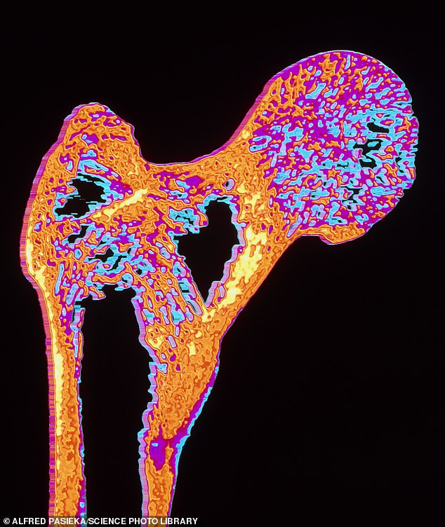 The team argued that their findings echoed calls to restrict certain types of UPFs and warned that higher amounts of fat in the thigh muscle could increase the risk of knee osteoarthritis. Pictured: An X-ray of the head of a femur of the femur affected by osteoporosis