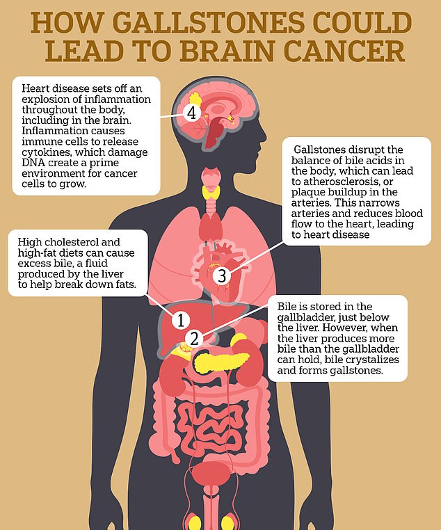 The chart above shows how gallstones can lead to heart disease, which has then been linked to brain cancer such as glioblastoma