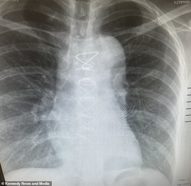 Above, an X-ray showing where surgeons inserted an artificial tube, called a graft, to replace the weak section of Ms Anderson's aorta