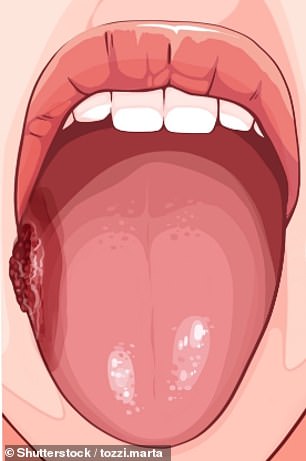 A persistent sore or lump on the side of the tongue is a sign of oral cancer