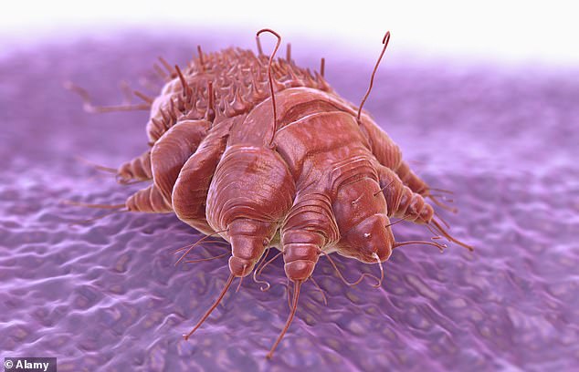 Scabies, more commonly associated with Victorian or Dickensian times, manifests as an intensely itchy, bumpy rash caused by the saliva, eggs and feces of the parasitic mite Sarcoptes scabiei (pictured)