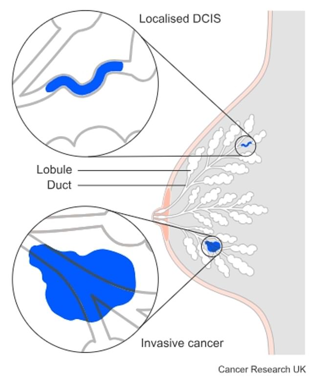 Under current UK guidelines, treatment to tackle cancer at its early stages involves surgery, which can then be followed by radiotherapy to kill any abnormal cells lurking in the breast tissue.