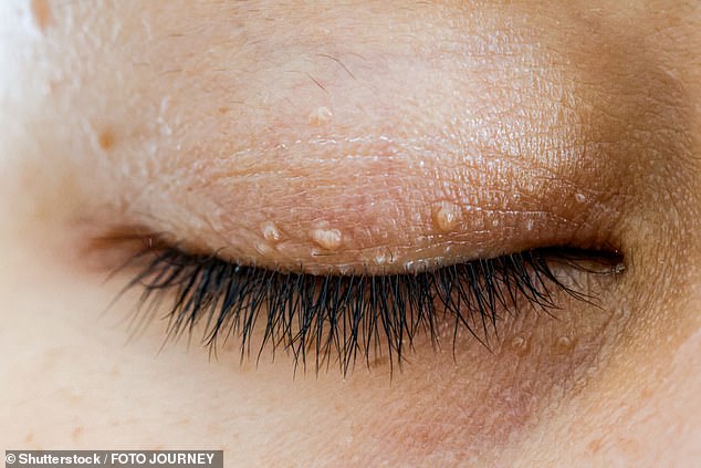 Skin tags can also indicate a possible diabetes diagnosis, especially around the neck or on the eyelids