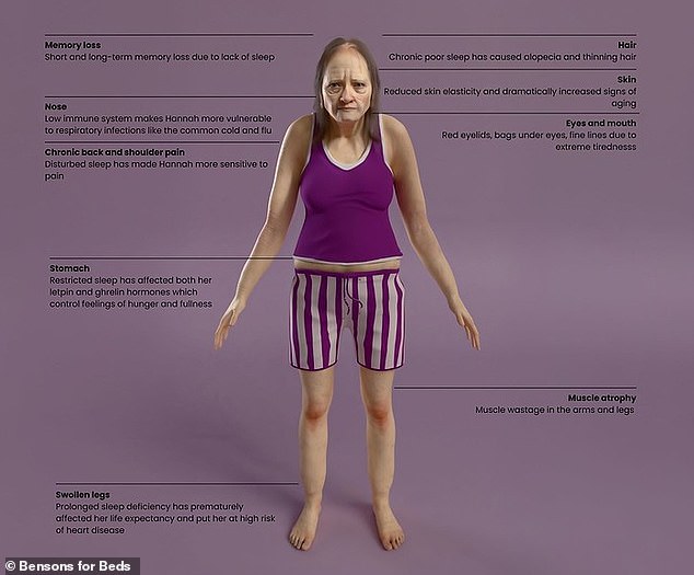 Hannah suffers from chronic back pain, thinning hair, sagging skin, swollen legs, baggy eyes and muscle atrophy (thinning of muscle mass) in the arms and legs