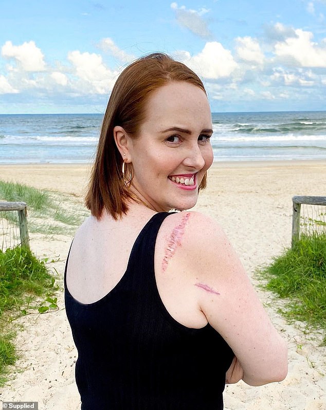 Courtney went for checkups every three months after doctors removed the birthmark from her shoulder